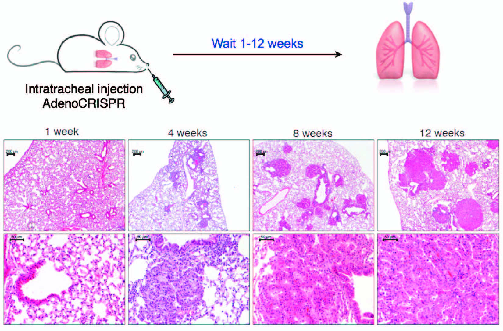 Histology of Eml4-ALk-driven cancers