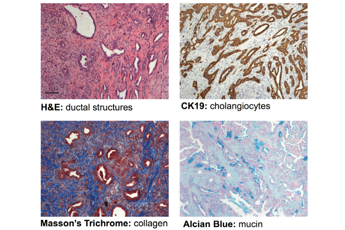 Figure 4.  A mouse model of intrahepatic cholangiocarcinoma used to validate FIG-ROS as a therapeutic target. -- Hepatoblasts are isolated from Kras mutant/p53 mutant mice and transduced with vectors expressing a gene or shRNA of interest. Cells are transplanted orthotopically into the liver where they produce a cancer mirroring the human disease (Saborowski et al., Proc Natl Acad Sci U S A, 2013).