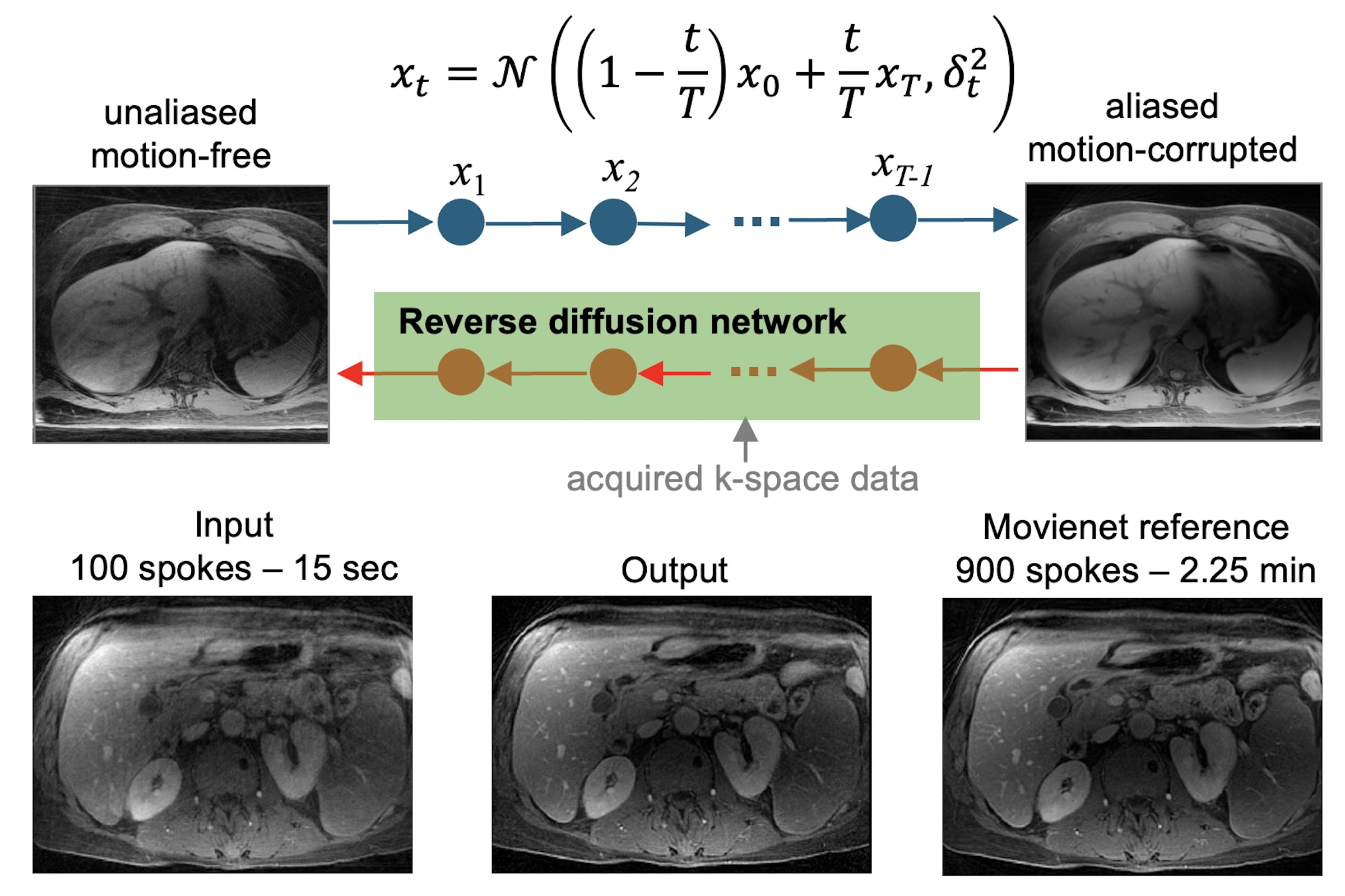 Top: Generative diffusion bridge approach. The forward bridge diffusion process gradually transforms the unaccelerated motion-free image to an accelerated motion-corrupted image by adding noise. The reverse bridge diffusion process uses a score function learned with a neural network. Bottom: Reconstruction of a testing case with 9-fold acceleration (100 spokes = 15 seconds scan time).