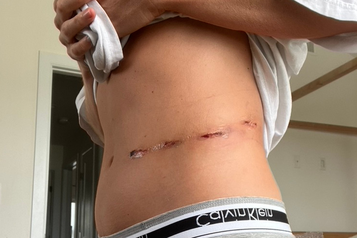 Amy Speck shows her incisions after surgery