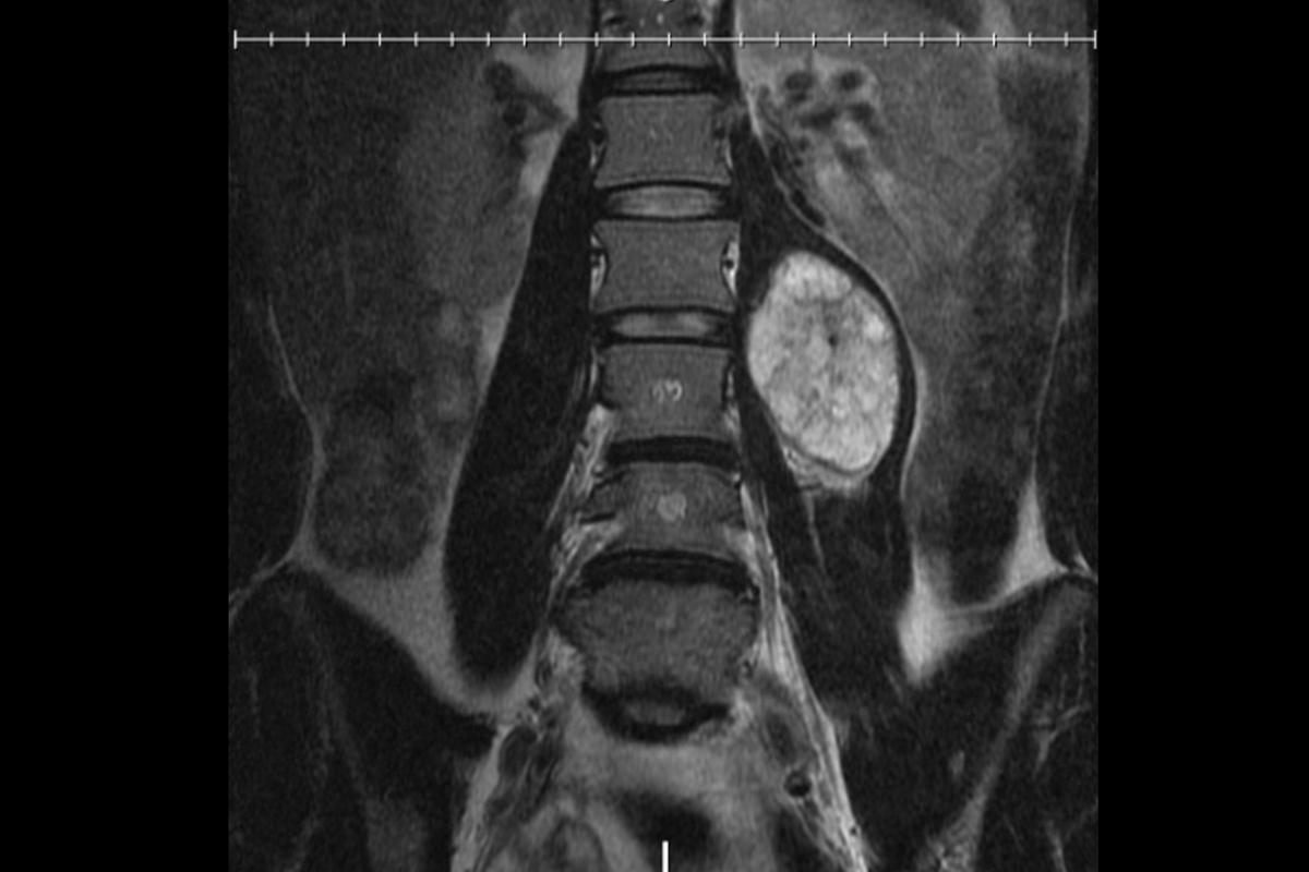 An image of a spine tumor
