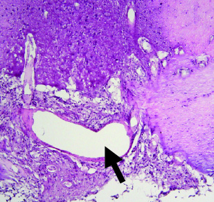 Histological section of a DIPG like tumor formed by engineered human ES cell progeny/ Arrow shows the basilar artery.