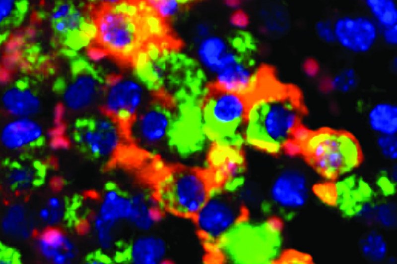 iron-filled macrophages from a breast cancer tumor