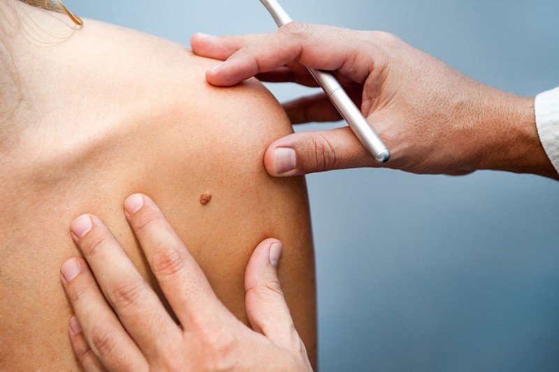 A doctor examines a mole.