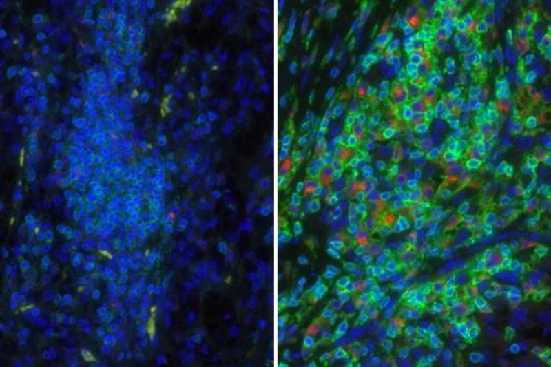 Side-by-side pictures of tissues from a responder and a non-responder to targeted therapy for kidney cancer