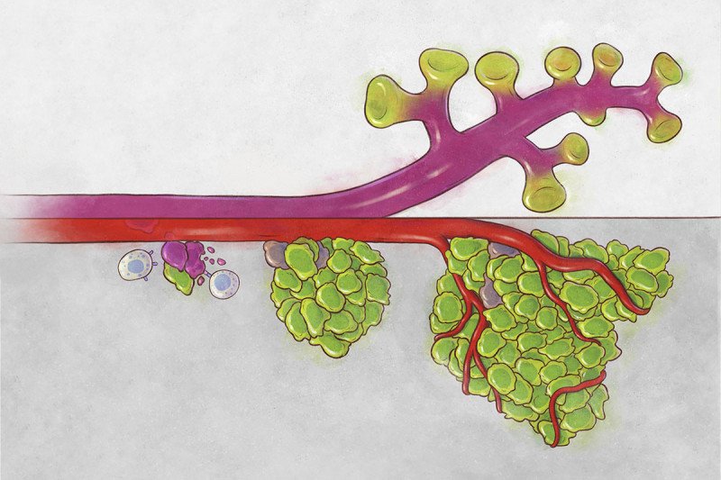 An illustration of lung develop alongside tumor evolution