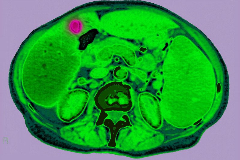 CT scan showing lymphoma in the abdomen between the liver and the gallbladder.
