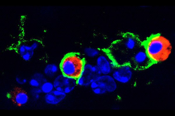 Mouse glioblastoma tumor with phagocytic macrophages