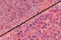 A microscopic view of genetically engineered mouse tumor and a human FL-HCC tumor