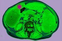 CT scan showing lymphoma in the abdomen between the liver and the gallbladder.