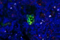 Microscopy image showing a quiescent cluster of lung adenocarcinoma tumor cells with low STING expression.