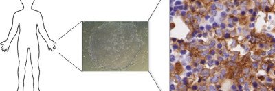Histology images of stem cells and AML cells