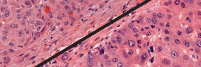 A microscopic view of genetically engineered mouse tumor and a human FL-HCC tumor