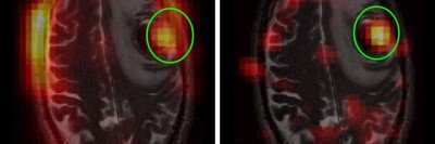 Side-by-side images of brain MRIs.