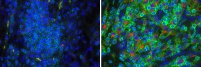 Side-by-side pictures of tissues from a responder and a non-responder to targeted therapy for kidney cancer