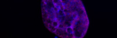A breast cancer cell containing micronuclei
