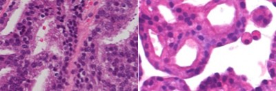Stained pathology slides of a patient’s tumor (right) and of an organoid made from that tumor (left).