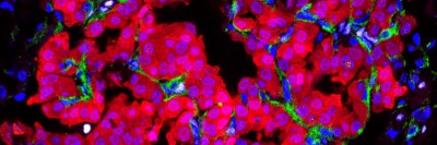 colorful microscope image of cancer cells