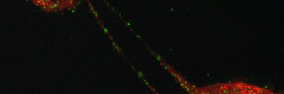 Pictured: Two mesothelioma cells connected by long extensions called tunneling nanotubes, which potentially may be a conduit for communication between the cells.