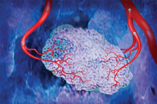 Rendering of a primary tumor mass with adjoining blood vessels (shown in red). Cells that have detached from the tumor and entered the bloodstream (shown as spheres) may circle back to the tumor and enhance its growth and aggressiveness.